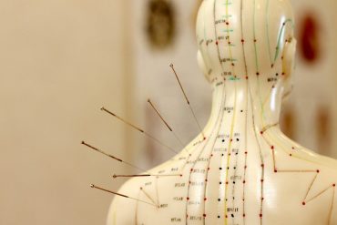 Traditional Chinese Acupuncture